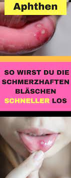 So Wirst Du Aphthen Schnell Wieder Los Aphthen Im Mund Aphten Im Mund Hausmittel Aphten Im Mund Kinder Aphten Auf Der Zunge Kids Health Body Health Health
