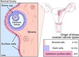 There is also an entity called ovarian low malignant potential tumor; Types Of Ovarian Tumors Ovarian Cancer Johns Hopkins Pathology
