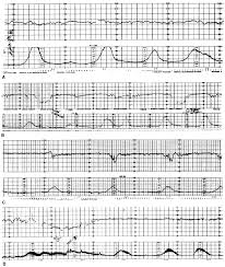 Image result for Non-Stress Test
