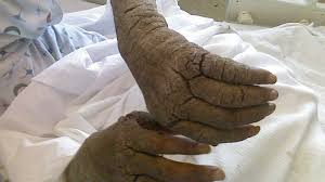 Image result for scabies human bites