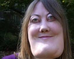 Victoria Wright è stata diagnosticata con cherubismo a 4 anni, una rara  mutazione genetica che deforma le ossa del volto e che rischiava di  lasciarla cieca se non fosse stata operata. L'intervento