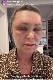 Day 3. Btw, Dr. Terry Dubrow is not her plastic surgeon 🤔