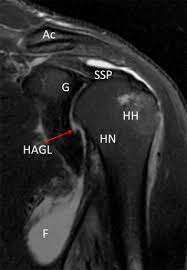 Hagl n (singular definite haglet, plural indefinite hagl). Arthroscopic Repair Of Humeral Avulsion Of The Glenohumeral Ligament Lesion Arthroscopy Techniques