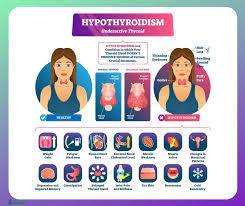 An underactive thyroid is also known as hypothyroidism. Underactive Thyroid Hypothyroidism Symptoms Causes Risk Groups And Treatment Ecosh Life