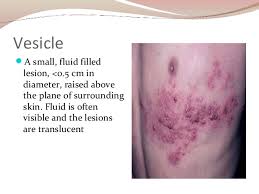 Skin Lesions