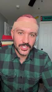 Aging Privilege: My Experience with a Hair Transplant