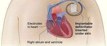 A pacemaker is a small device that's placed under the skin in your chest to help control your heartbeat. Implantable Cardioverter Defibrillators Your Questions Answered Latest News Cardiomyopathy Uk