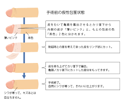 青山セレスクリニックの包茎手術の方法 青山セレスクリニック