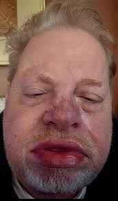 Can anyone recommend a dentist for a tooth extraction in Rome, NY?