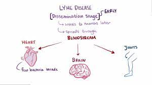 However, we saw a large increase in infection rate only in sussex county, where there is a corresponding increase in the proportion of i. Lyme Disease Infectious Diseases Msd Manual Professional Edition