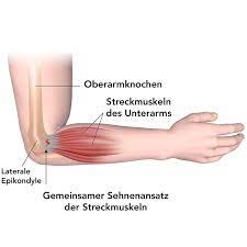 Hier erfährst du die ursache bei einem tennisarm ist der sehnenansatz entzündet, der die muskulatur mit dem ellenbogenknochen verbindet. Tennisarm Ursache Symptome Behandlung Und Ubungen Liebscher Bracht