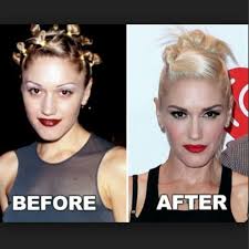 Gwen Nose Jobgwen Gwen May Refer To Plastic Surgery Laser Hair Botox