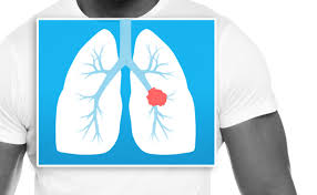 Need to translate cáncer from spanish? Immunotherapy For Lung Cancer Cancer Research Institute Cri