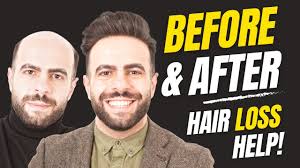 How to Apply (Attach) a Non-Surgical Hair Replacement System for Men/Women  UK/USA/International