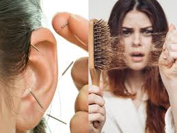 They found that garlic applied topically to the scalp beat the. Acupuncture For Hair Loss How Does It Help Times Of India