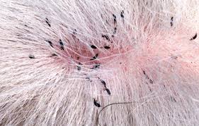 Kelemumur, kutu, keguguran rambut, kulit kepala berminyak, semua berkaitan kulit kepala,kudis kepala.make order dm. Kutu Rambut Punca Simptom Dan Rawatan The Diagnosa