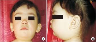 Broad nasal bridge & epicanthal folds symptom checker: Hennekam Syndrome A Case Report