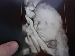 Ultrasound 33 Weeks Soft Marker For Down Syndrome Babycenter