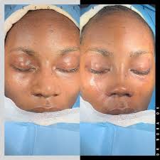 My beautiful patient sent her follow up photo and we would like to share  this beautiful outcome with you. She is like born with her new nose even  soon after #ethnicrhinoplasty surgery.