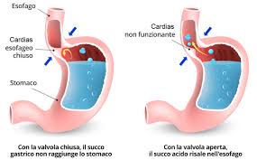 Il quadro esatto di un attacco cardiaco. Studio Dott Carrara Reflusso Gastrico E Alimentazione