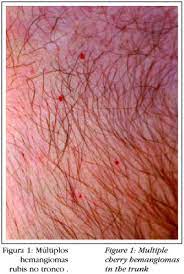 Cherry angioma is a type of tumor or cyst that attacks people above 40 and is marked by the presence of lesions or red color. Cherry Hemangioma In The Scalp
