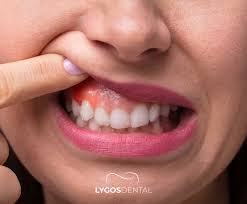 Image result for gums cancer symptoms