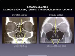 Image result for Sinus CT