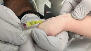 Image result for Difficult Intravenous Access in Children
