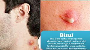 Yang perlu diperhatikan untuk mengatasi bisul pada kepala bayi. Cara Mengobati Bisul Tanpa Harus Ke Dokter Begini Langkahnya Hingga Bersih Dan Bisul Langsung Pecah Halaman All Sriwijaya Post