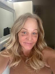 Facial Surgery Experience with Face-lift, Neck-lift, and Brow Lift