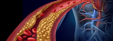 Image result for Hypercholesterolemia