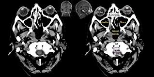Image result for CT Head