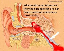 Otitis Media What Is Going On In Your Head Ear Infection Middle Ear Natural Cures