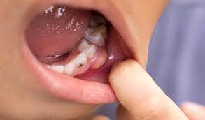 Urgencias Dentales En Getxo Clinica Dental Letamendia