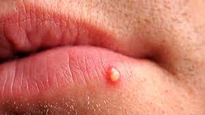 Basically, is this a common place for pores to become irritated or for regular old pimples to form? Is It Herpes Or Something Else Everyday Health