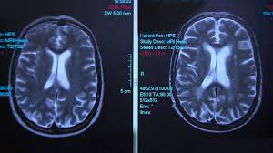 Check spelling or type a new query. The Dual Stigma Of Alcohol Related Brain Damage Bbc News