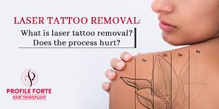 We reveal how much your tattoo removal procedure is likely going to hurt. Laser Tattoo Removal What Is Laser Tattoo Removal Does The Process Hurt