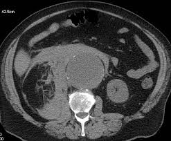 Make your appointment here real id driver licenses and id cards are processed here. Abdominal Aortic Aneurysm Ct Scan Wikidoc
