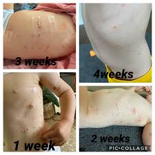 A molluscum contagiosum outbreak causes inflamed, small, pearly nodules often found in clusters. Mollenol Posts Facebook