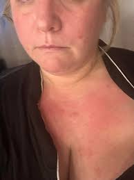 2 days ago I broke out in hives
