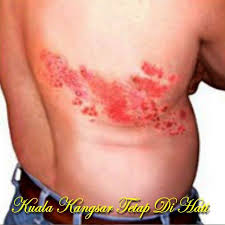 Betul ke kayap ular boleh membawa maut?? Kuala Kangsar Always In Our Heart Penyakit Kayap Mengikut Laporan Kesihatan Kayap Atau Shingles Disebabkan Oleh Jangkitan Sejenis Virus Dikenali Varicella Zoster Virus Atau Vsz Virus Ini Adalah Virus Yang Sama Yang Menyebabkan