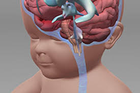 Hydrocephalus - Stanford Medicine ...