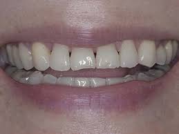 How to fix a teeth gap without braces, dental crown and bridge. Black Triangles Between Teeth Missing Gum Between Teeth