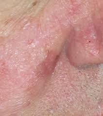 Older cats and those with white ears and heads are especially susceptible to skin cancer. Lentigo Maligna Wikipedia