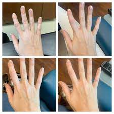 My Skin Before During And After An Iron Infusion 6 Hours Between The First And Last Photo Evmore Electric Vehichle Iron Infusion Infused Iron