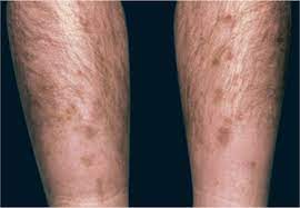 Updated daily, the critical care reviews journal watch is the only platform to keep you current across the entire medical literature. Skin Manifestations Of Diabetes Mellitus Endotext Ncbi Bookshelf