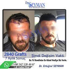 Antalya Sac Ekimi Sac Ince Saclar Sac Dokulmesi