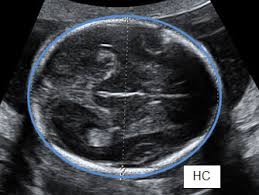 Ultrasound Scan Fetal Growth Scan Patient Information