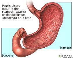 Peptic Ulcer: Medlineplus Medical Encyclopedia