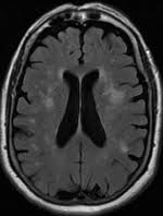 Leukoaraiosis Wikipedia